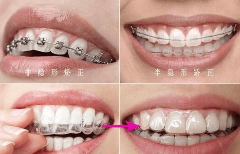 广州25岁还能矫正牙齿吗？看完这篇不再纠结
