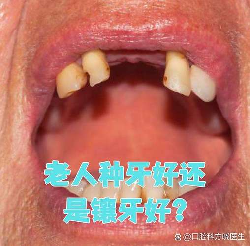 广州74岁老人种牙晚不晚?医生揭秘高龄种植的真实风险与收益