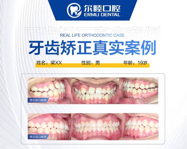 深圳牙齿矫正报价_深圳矫正牙齿多少钱_深圳牙科矫正价格表