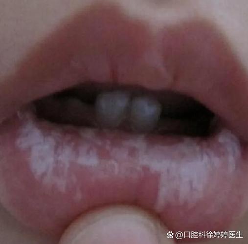 广州儿童口腔有白色黏膜到底严不严重