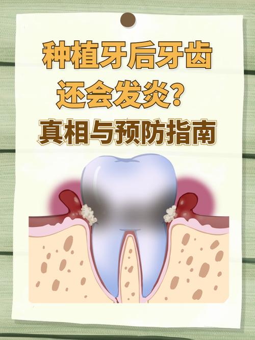 广州种植牙严重松动发炎，什么情况需要拔除？