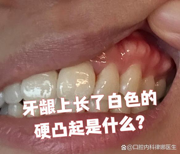 广州缺一颗牙一定要种吗 不种的后果你承受得起吗