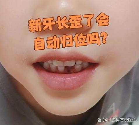 广州六岁孩子门牙长歪先别慌 看这几种矫正办法