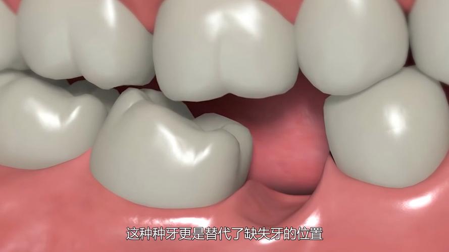广州种牙到底疼不疼？一篇说清楚植牙真相