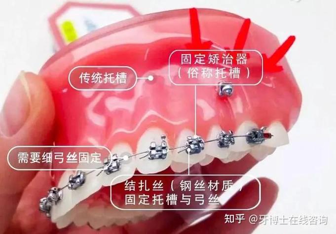 广州深圳龙岗做隐适美矫正到底要花多少钱？