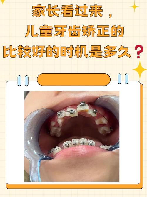 广州8岁做牙齿矫正早不早？看情况，地包天要趁早