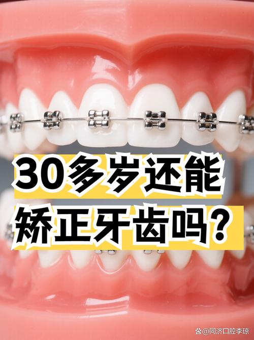 成人矫正牙齿的年龄限制吗_成年了做牙齿矫正_成年人牙齿矫正适合吗