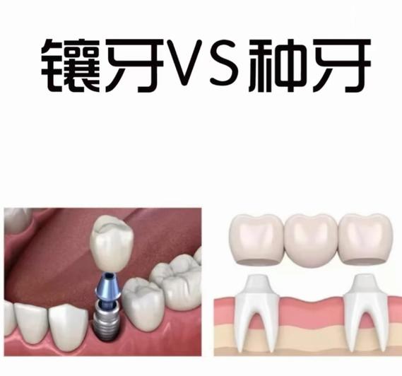 广州海口种植牙2026价格：单颗4000-6000元真实吗
