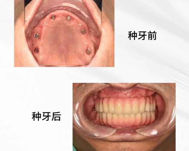 广州全口种植牙手术到底怎么做