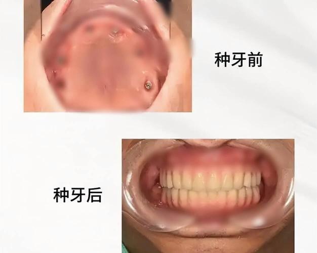 广州70多岁还能种牙吗？种牙风险大不大？