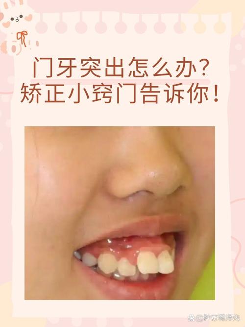 广州10岁孩子门牙突出，医生揭秘：抓住黄金期，这个最快