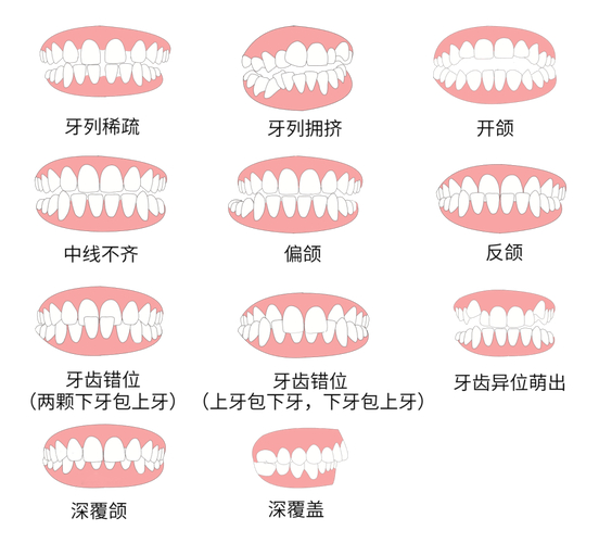 广州30岁做牙齿矫正到底值不值 利与弊全分析