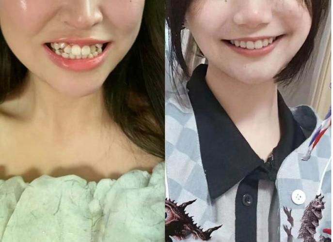 广州36岁还能矫正牙齿吗 成人正畸的真相与风险