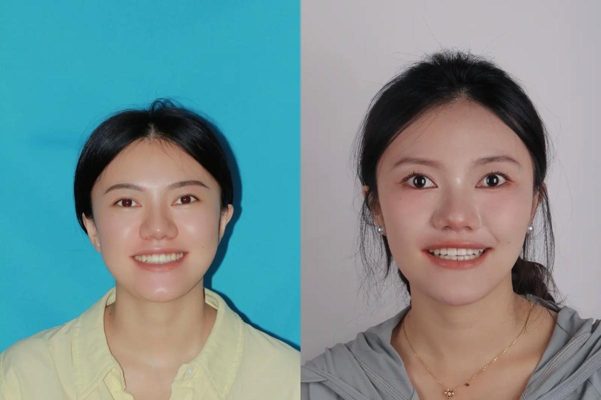 广州20岁矫正牙齿晚不晚?过来人告诉你真实答案