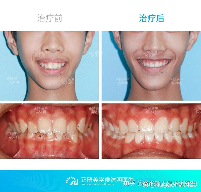 龅牙矫正完后会不会反弹_龅牙矫正完可以改善脸型吗_30岁龅牙可以矫正回来吗