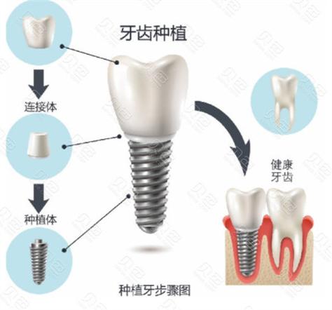 广州九江威高种植牙多少钱一颗2026最新价格