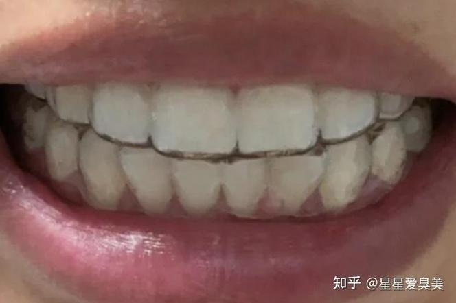 22岁 矫正牙齿_牙齿矫正费用大概多少_牙齿矫正的十大危害