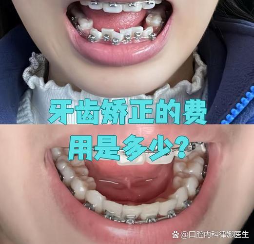 广州30岁矫正牙齿一般花多少钱