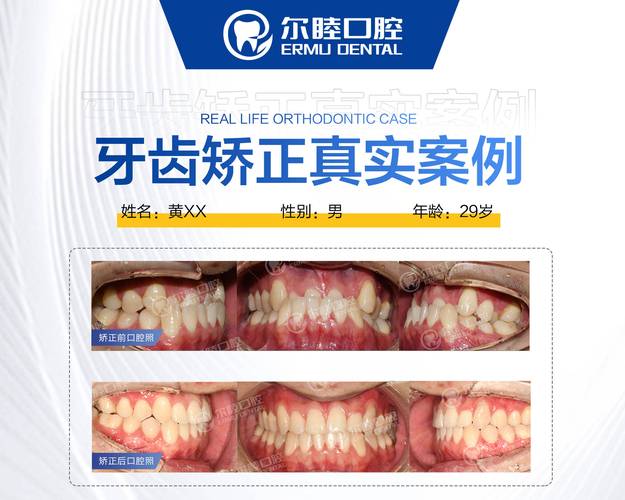广州深圳南山做MRC矫正哪家医院靠谱？