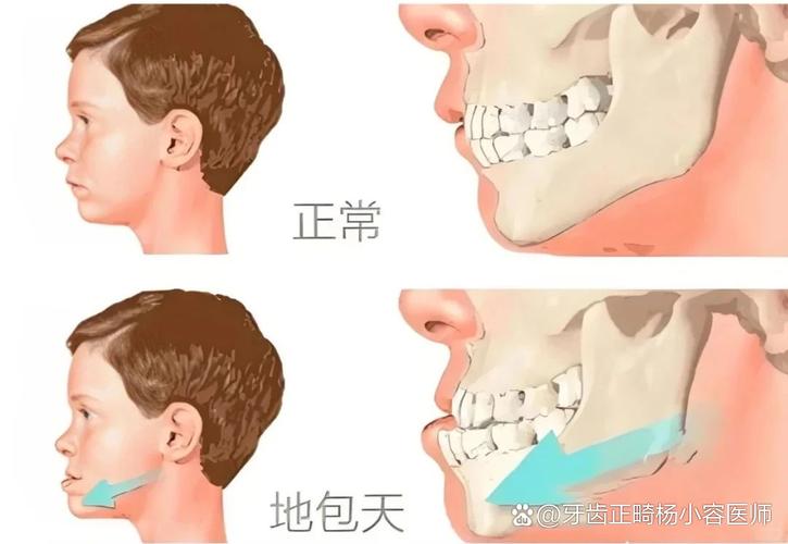 广州12岁小孩能做牙齿矫正吗?别等换完牙才后悔