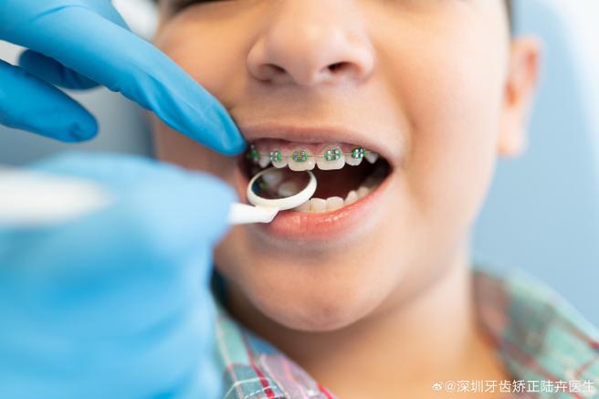 广州8岁孩子门牙龅牙矫正方法 儿童早期干预怎么做
