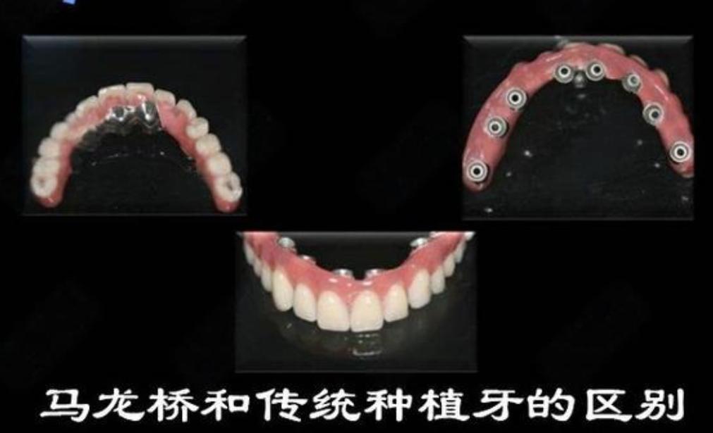 广州大同种牙哪里好 选公立还是私立更靠谱
