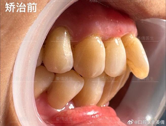 广州60岁还能做牙齿矫正吗