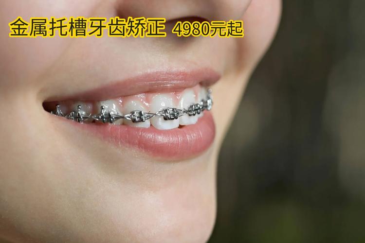 广州珠海做牙齿矫正,不同牙套要花多少钱?