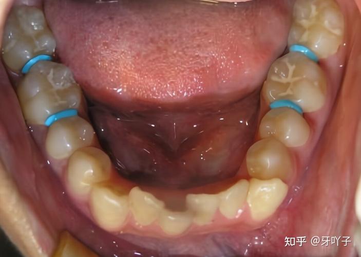 广州玉林牙齿矫正效果怎么样?看完这篇就心里有数了