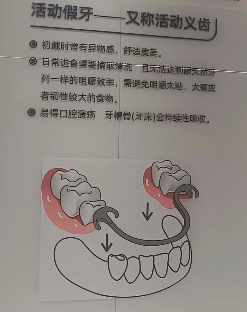广州活动假牙固定假牙种植牙哪个好 牙医一次说清别再被忽悠