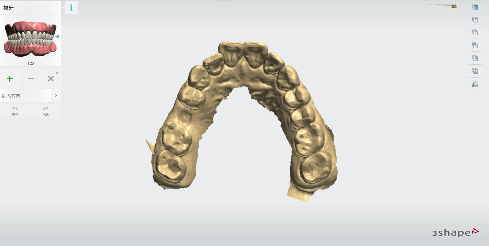广州3D导板数字化种植牙：告别传统盲种，种牙更精准更安心