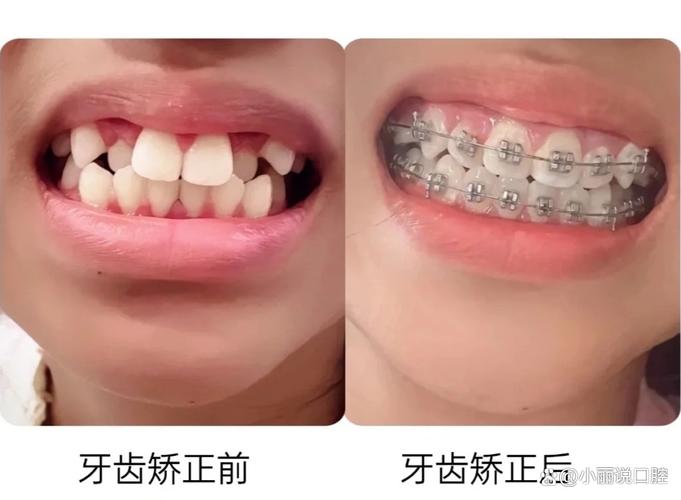 广州15岁牙齿不齐怎么办 专家说三种矫正方式哪种最适合你
