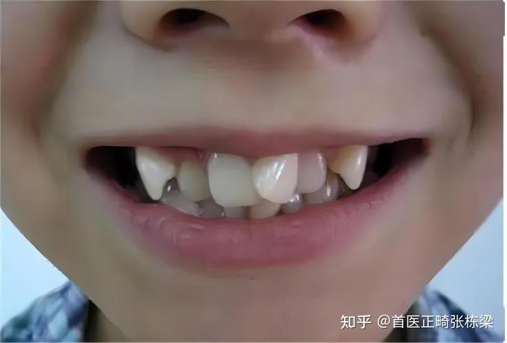 广州深圳儿童地包天最佳矫正年龄是多少？别等换牙误了大事