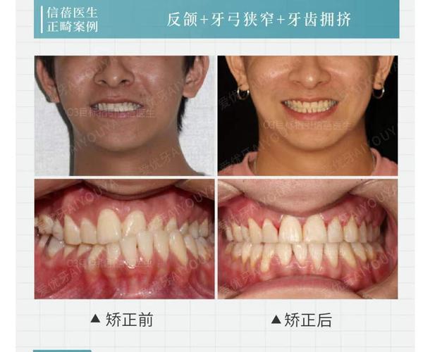广州深圳中学生牙齿矫正优惠活动真的靠谱吗？