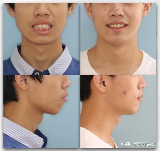 广州呼和浩特牙齿矫正靠不靠谱？效果真实揭秘