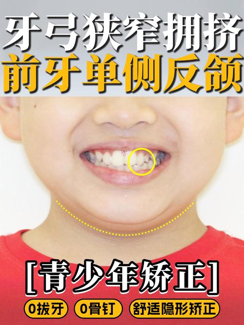 矫正过程中门牙歪了_儿童门牙长歪了怎么办,啥时矫正_孩子矫正门牙
