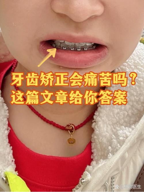 广州19岁做牙齿矫正晚不晚 过来人告诉你真实经历