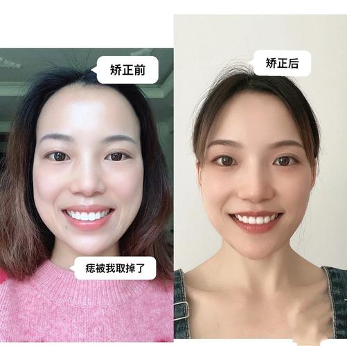 广州成年人牙齿矫正还来得及吗