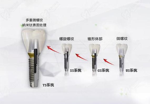 广州唐山韩系奥齿泰种植牙2026最新费用一览