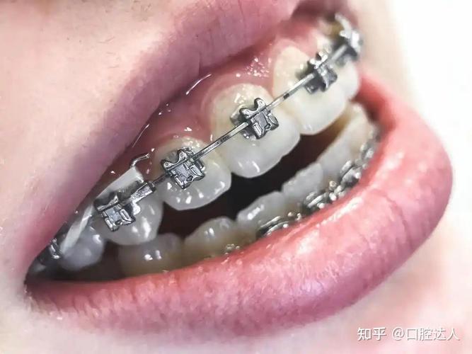 苏州牙齿正畸费用_深圳福田青少年钢丝正畸费用_深圳钢丝矫正牙齿大概多少钱