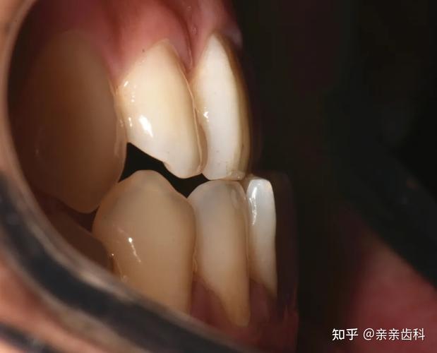广州宿迁牙齿矫正大概要花多少钱？本地人帮你算笔账