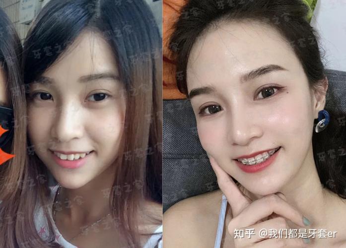 广州43岁矫正深覆合牙齿要多少钱？从检查到摘牙套费用全掰扯清楚