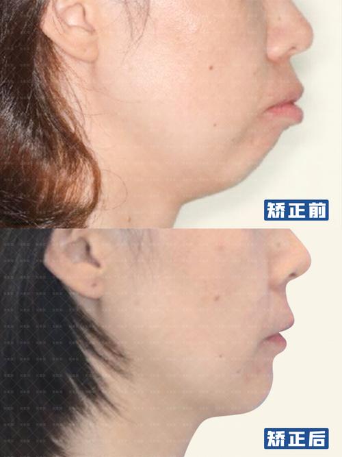 广州矫正牙齿能改善下巴后缩吗？3个关键问题正畸医生一次说清
