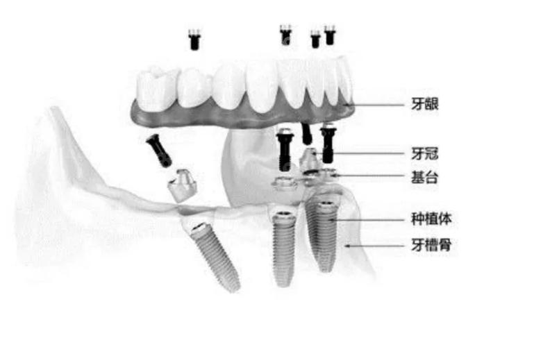 广州半口种牙费用不固定 一颗大概多少钱