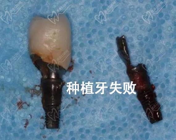 广州深圳福田单颗种植牙哪家医院靠谱?看这里就对了!