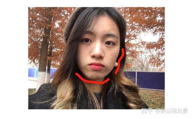 广州莲塘小孩正畸多少钱?费用明细和避坑指南