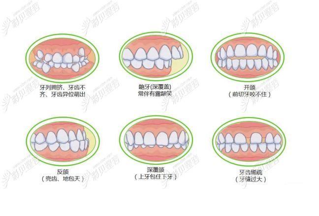 广州南阳牙齿矫正多少钱？2026最新价格大公开