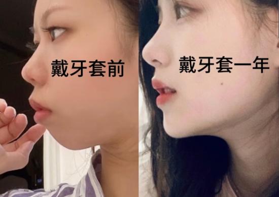 广州郴州做牙齿矫正哪家好？看完这篇不踩坑