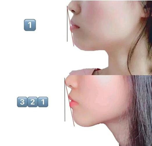 广州34岁做龅牙矫正还来得及吗?我的真实感受