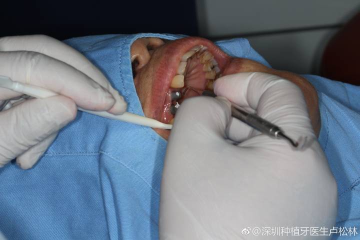 广州80岁还能种牙吗?医生说只要满足这个条件就能做